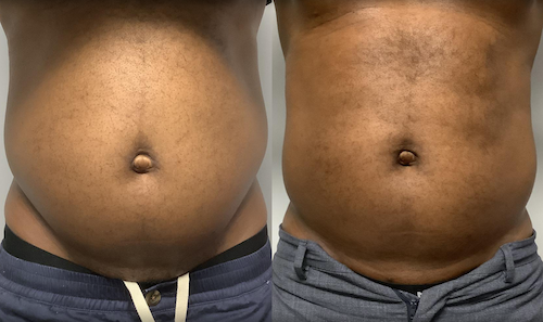 Stomach Sculpting Fat Reduction Before After Mississauga Oakville